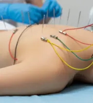 Electroacupuncture